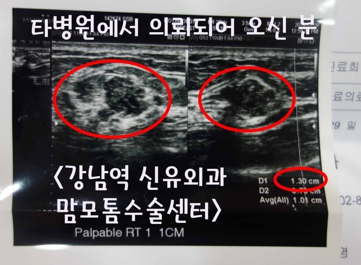 맘모톰수술후기 <겨드랑이접근법>
