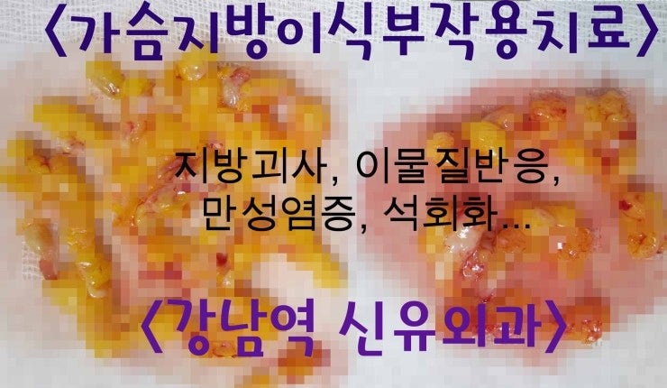 가슴지방이식 1년후 멍울잡혀 석회화부작용치료받으신 후기