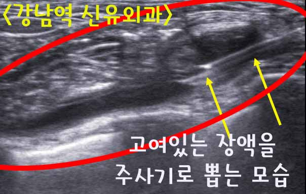 맘모톰수술후기, 가슴보형물제거(타병원)후 고인 장액종흡입과 함께. 