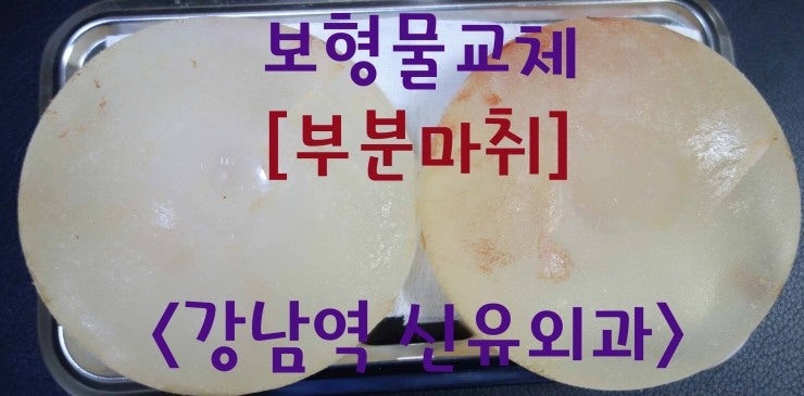 가슴보형물교체수술후기 ; 코겔실리콘 제거하고 새로운 팩을 넣음 (부분마취로)
