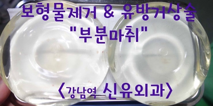 가슴보형물제거와 유방거상수술 후기. ; 부분마취로만!!!!!