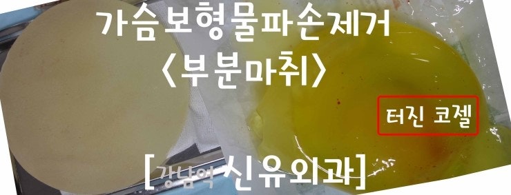 50대 여성분의 유방거상술(가슴리프팅)과 보형물파손제거수술후기<부분마취>