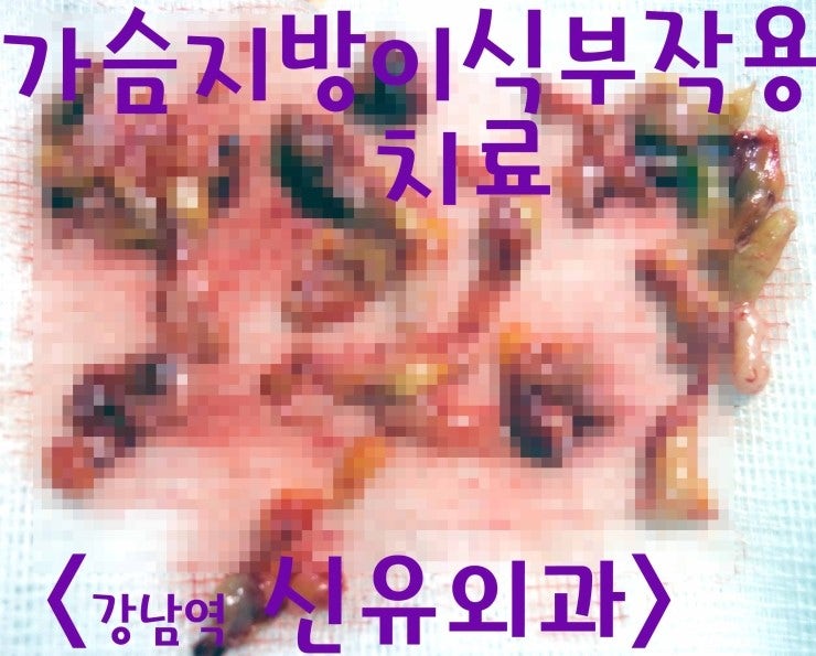가슴지방이식부작용석회화 급성염증치료후 피곤해서 다시 재발, 고름나온 분 후기