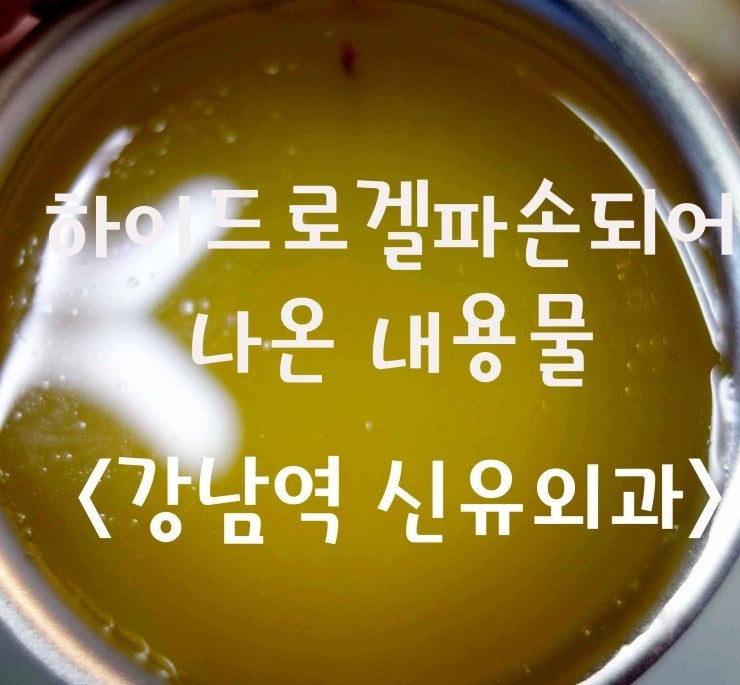 15년되어 파손된 하이드로겔가슴보형물제거수술후기 : 부분마취