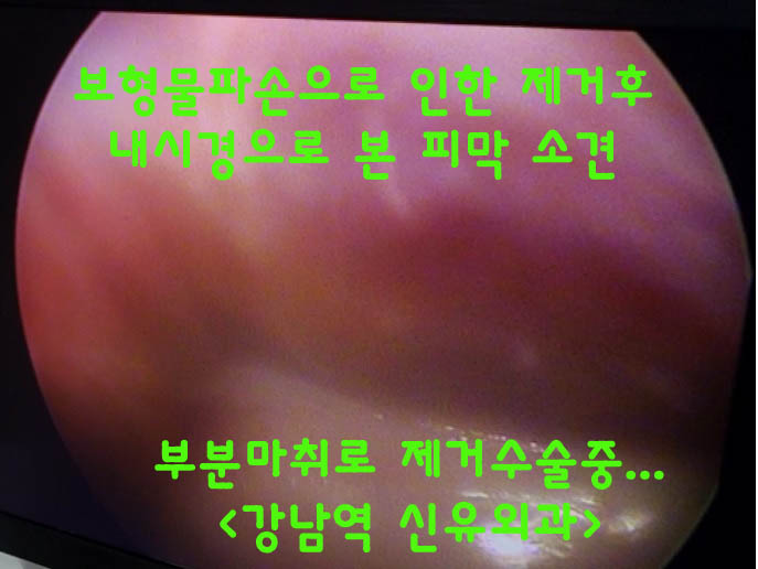 처진가슴(유방하수)을 리프팅(거상술)을 하면서 보형물파손도 부분마취로 제거했던 분의 수술후기. 