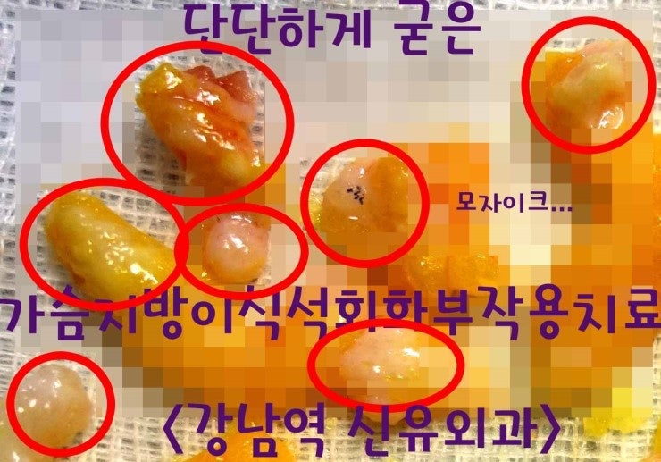 가슴지방이식석회화부작용치료수술후기. 단단한 이물질반응석회화염증이 나왔던 분. 