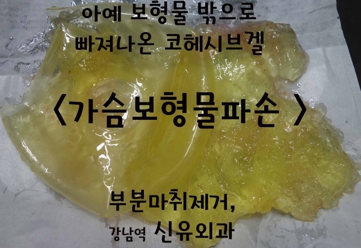 처진가슴 가슴보형물파손후제거수술후기. 