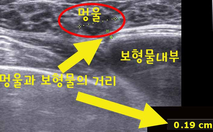 가슴성형수술후보형물맘모톰시술후기. 거리가 2mm에 불과했던 분.