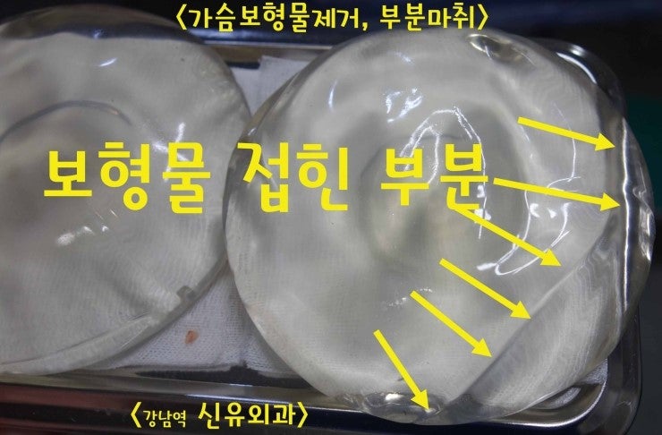 구형구축때문에 보형물이 여러군데 접혀서 8년만에 제거수술후기. 
