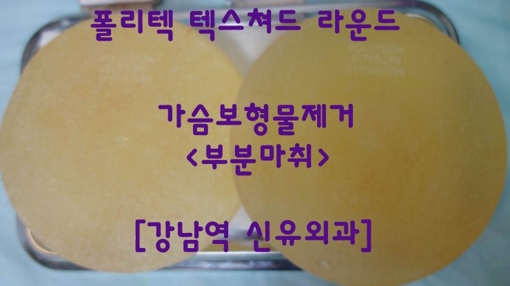 구형구축때문에 가슴보형물여기저기 접혔던 분 제거수술후기. 