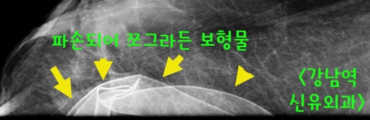 생리식염수가슴보형물백파손제거수술때 피막 일부도 같이 부분마취로 제거했던 분.