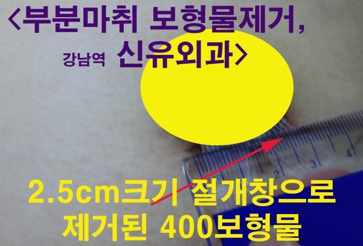 가슴보형물제거수술 400cc도 2.5cm 유륜주위절개로 부분마취 제거