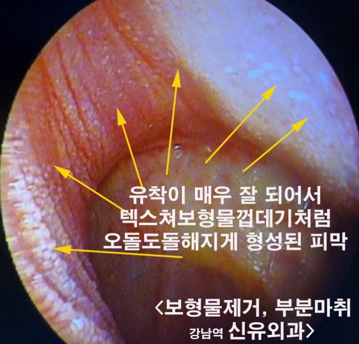 피막이 보형물에 단단히 유착되어 있었던 가슴보형물제거수술
