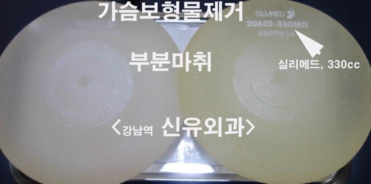 가슴성형후 갑자기 커져서 다량의 장액을 제거하고 보형물제거, 가슴거상술, 비대칭교정술까지 동시에 부분마취로 수술받으신 분. 