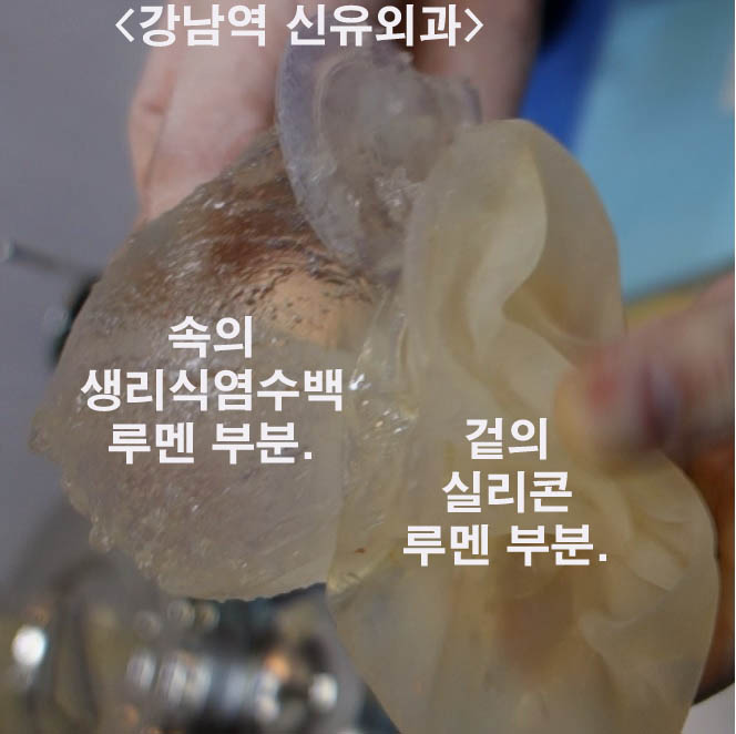 속의 팩은 생리식염수로 채워져있고, 겉의 팩은 실리콘으로 채운 더블루멘(double lumen)타입 가슴보형물제거부분마취.