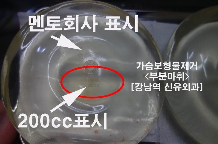 임신출산수유후처진가슴교정술.  : 보형물제거수술과 동시에.