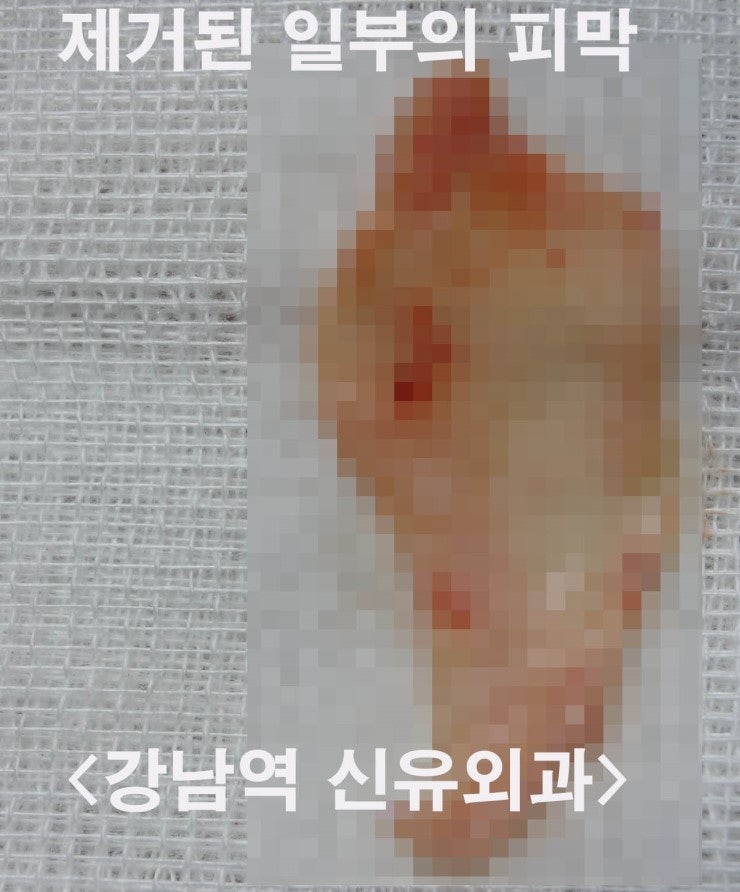 보형물이 접혀서 피막을 일부제거하고 주변피막으로 봉합하여 방의 변위를 막아주었던 가슴재수술 증례.