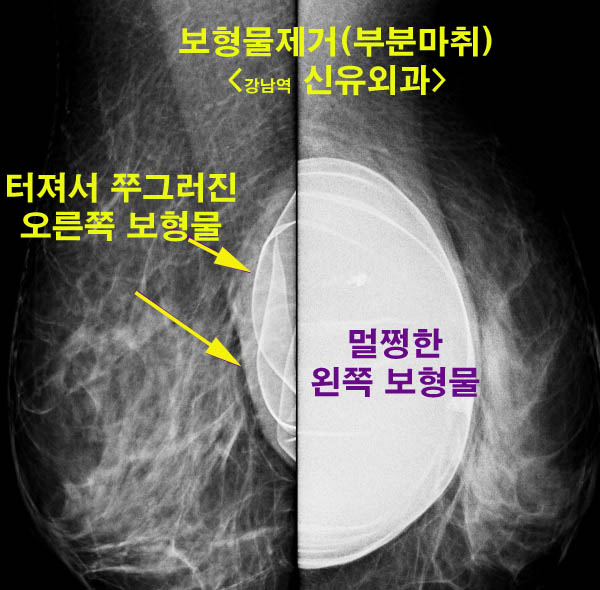 생리식염수팩파열 --> 가슴보형물제거와 유방거상술(리프팅) 동시 수술 (부분마취라니...) ^^::