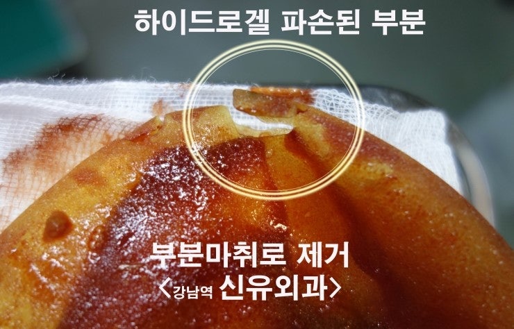 하이드로겔파손으로 가슴이 터지려고 해서 급히 제거수술하신 분. 