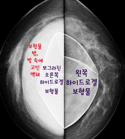 17년만에 하이드로겔보형물파손, 터져서 가슴이 갑자기 커져서, 부분마취로 급히 제거한 증례.