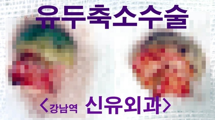 유두축소수술과 보형물맘모톰시술을 같이 받으신 분