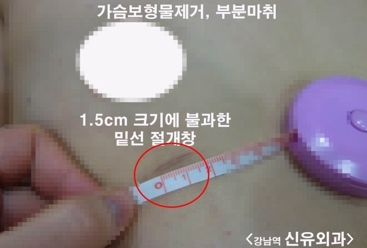 유방밑선절개 1.5cm크기로, 생리식염수백을 부분마취하여 제거한 증례.