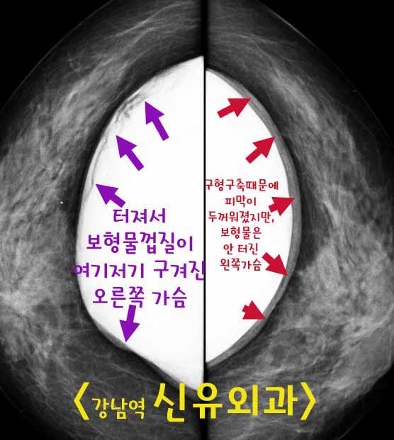 파손된 가슴보형물제거하고 처진가슴 유방거상술을 동시에 시행한 후, 4개월지나 역시 부분마취로 125cc 작은 보형물 넣으신 분