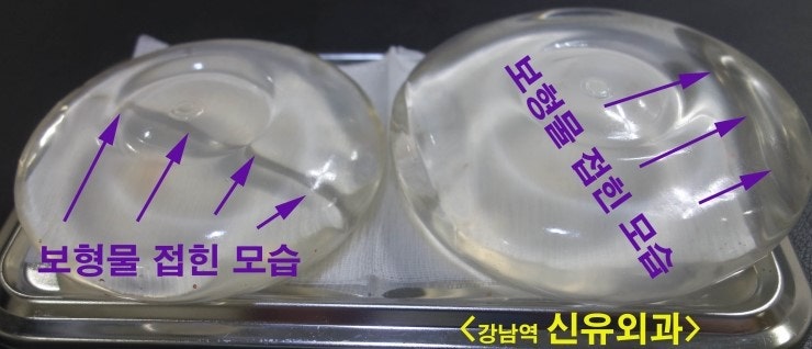 가슴보형물.제거와 거상술을 동시에 부분마취로 받으신 분 후기