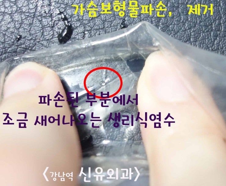 보형물파손으로 제거도 하고, 가슴지방이식부작용치료도 받으신 분의 수술후기