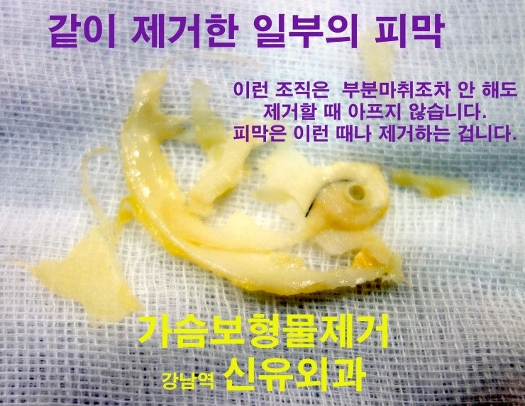 보형물제거수술.에서 유방하수거상술(가슴리프팅)을 고려해야 하는 증례.