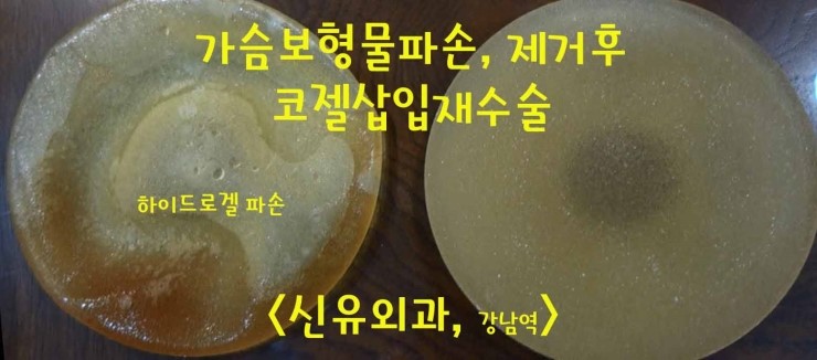 하이드로겔보형물파손, 제거후 약 1년지나서 다시 오셔서 코젤로 확대성형수술 : 후기. 