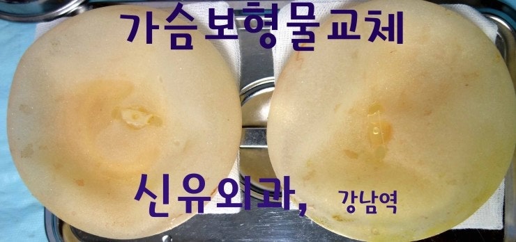 겨드랑이절개로 내시경으로 밑선교정하면서 보형물교체한 경우.