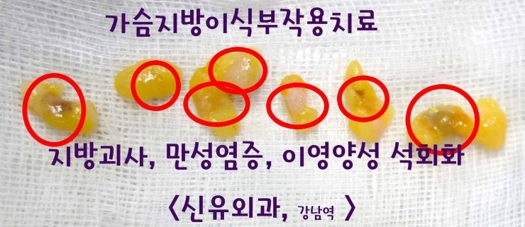 보형물수술도 실패하고, 가슴지방이식부작용 생겨서 어떤 성형외과에서 의뢰되었던 분 치료후기. 