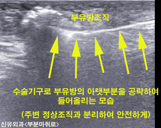 부유방제거수술전후사진, 1주후에도 멍이 하나도 들지 않았습니다. ^^