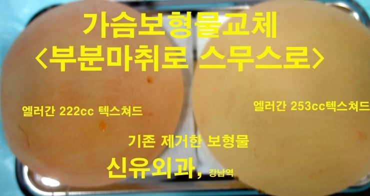 가슴보형물교체 부분마취, 감촉좋은 스무스로, 마사지 필요없이.