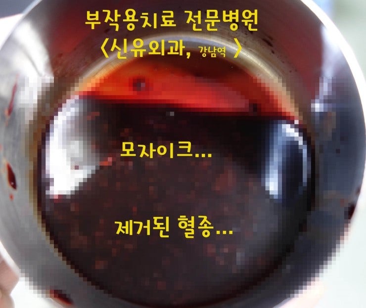 수술부작용에 대처하는 우리의 자세 : 특히 혈종, 장액종 
