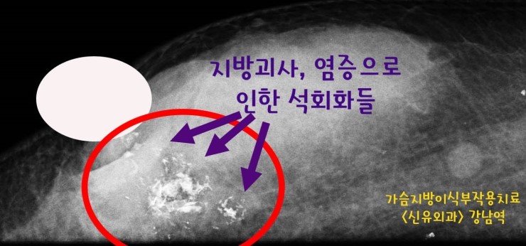 <가슴지방이식성형수술로 부작용생겨 타병원조작후 고름이 피부로 터져 나왔던 분>