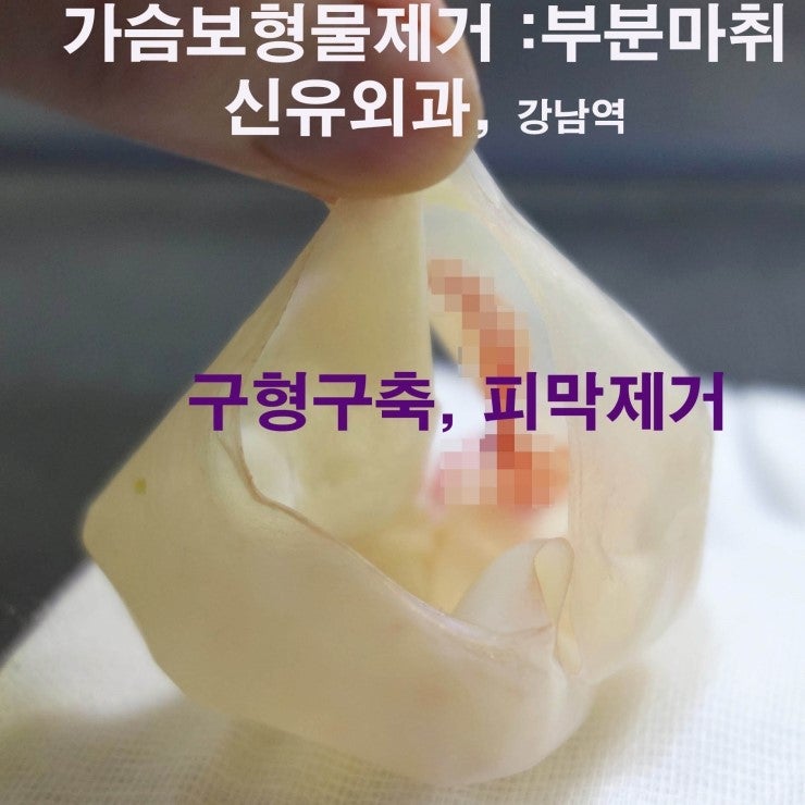 부분마취로 구형구축 온 피막제거하면서 가슴보형물제거수술한 증례 
