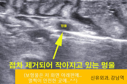 가슴성형후맘모톰시술이 0.08cm 떨어져 있을 뿐인데도 안전하게 시행된 증례.
