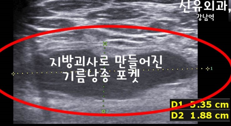 가슴지방이식부작용으로 지방괴사 기름낭종 포켓이 터져서 뽕뽕 주르륵 흐르던 분