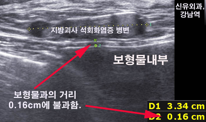 보형물있는 상태에서 가슴지방이식부작용석회화치료한 경우 : 신유외과, 강남역   