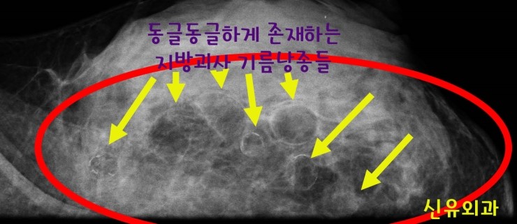 가슴지방이식부작용치료때문에 어떤 성형외과에서 추천받고 오신 분