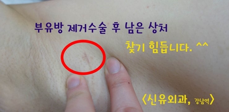 겨드랑이부유방수술 흉터크기사진