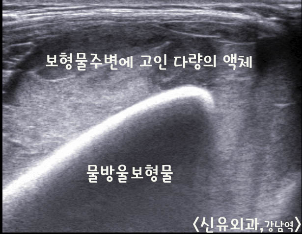 물방울가슴성형수술 3년후 갑자기 커져버린 가슴 : 보형물주위에 고인 600cc 이상의 장액종, 혈종