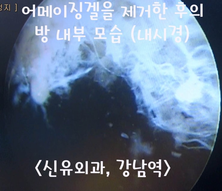 15년만에 제거한 어메이징겔