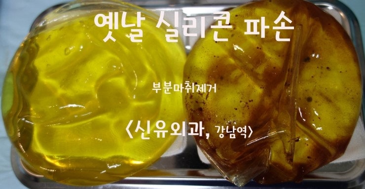 23년전의 옛날 실리콘파손제거수술후 혈종, 염증 생겼던 분
