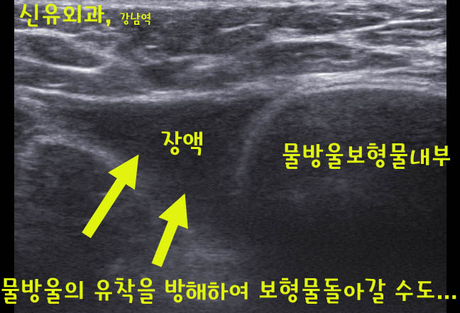임신출산수유후 처진가슴을 물방울보형물을 넣으면서 같이 유방하수 거상술(리프팅)을 한 경우