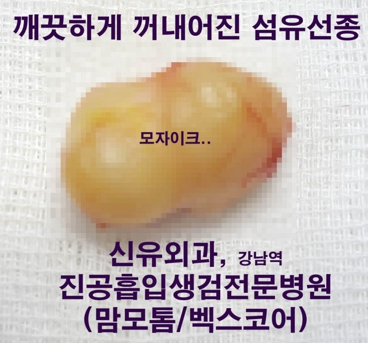 섬유선종의 실제 모습 사진.  
