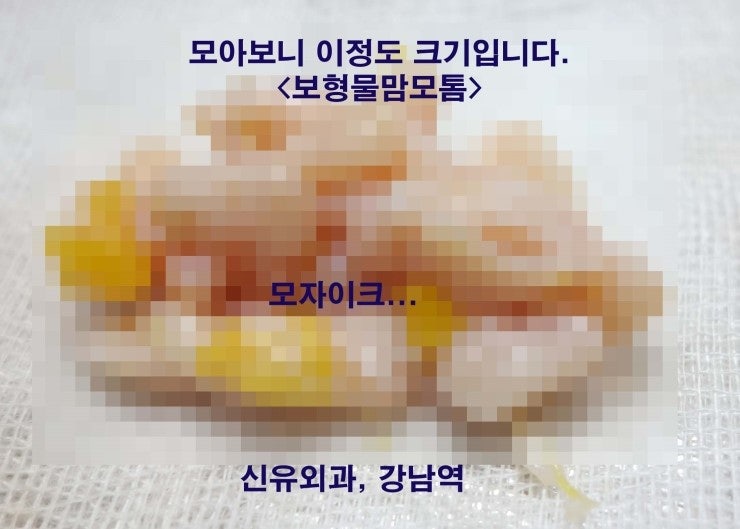 보형물 있는 상태, 커다란 유방멍울 맘모톰: 4cm가 넘는 멍울도 보형물파손 없이 안전하게!