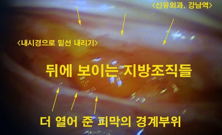 접혀서 파손된 가슴보형물을 부분마취 제거하고 밑선 교정하면서 스무스 200cc로 교체 :구형구축이 아니고...